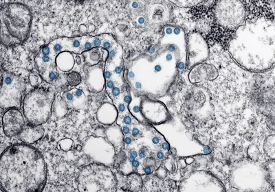 A micrograph from the first US case of COVID-19, with SARS-CoV-2 virus particles in blue
